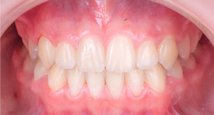 Le « syndrome du fil » de contention collé en orthodontie – L